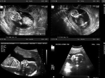 助孕生下的宝宝有没有缺陷(试管婴儿会有遗传病吗)